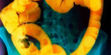 Kolon Kanseri Genç Yetişkinler Arasında Artıyor: İşte Dikkat Etmeniz Gereken BelirtilerÇeviri 